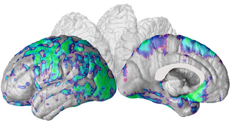 MRI map of the language network in patient with Alzheimer's disease. Image courtesy of Dr. Liana Apostolova, Department of Neurology, David Geffen School of Medicine, UCLA.