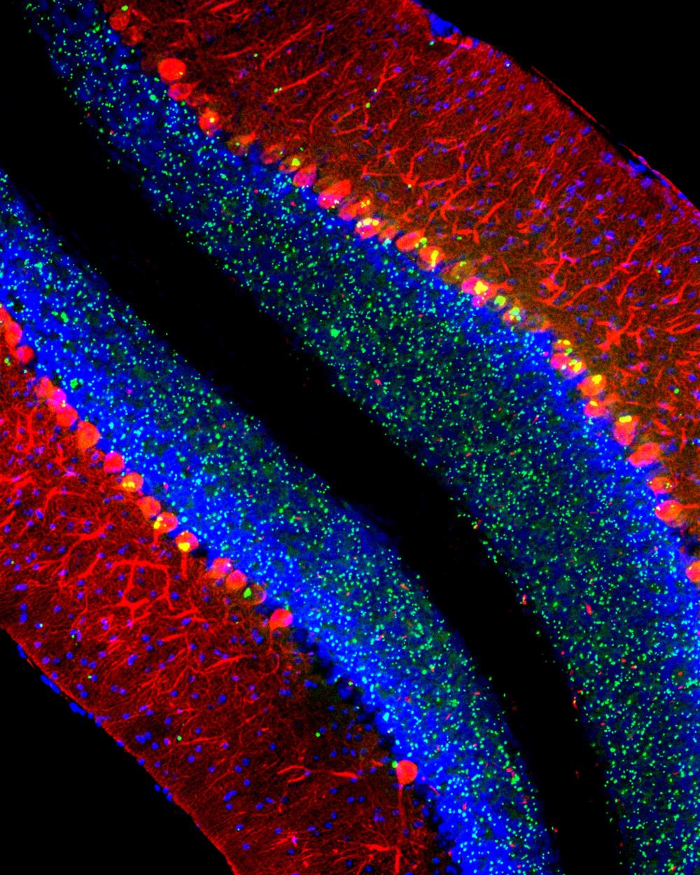 Cerebellum of a mouse modeling the lysosomal disease late-infantile neuronal cerold lipofuscinosis (CLN2 disease). Purkinje cells are labeled redm nuclei blue, and abnormal clumps of the protein p62/Sqtsm1 are green. (2018) Courtesy, with permission: Micsenyi et al., 2013, JNeurosci, 33 (26) 10815-10827. 