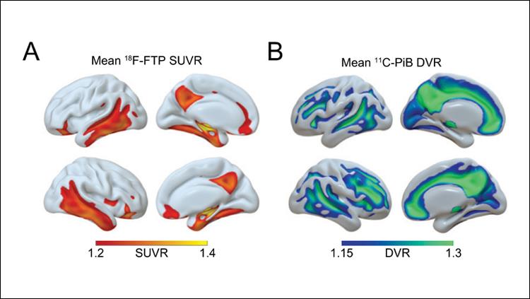 Sleep History Predicts Late-Life Alzheimer's Pathology