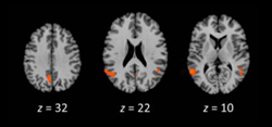 Telling a story, no matter the medium, activated a “narrative hub.” This includes (from left to right) the posterior cingulate cortex, the temporoparietal junction, and the posterior superior temporal sulcus. Source: Yuan et al., Journal of Cognitive Neuroscience 2018